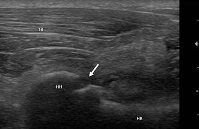 Shoulder Lameness in Dogs: Preliminary Investigation on Ultrasonography, Signalment and Hemato-Biochemical Findings Correlation